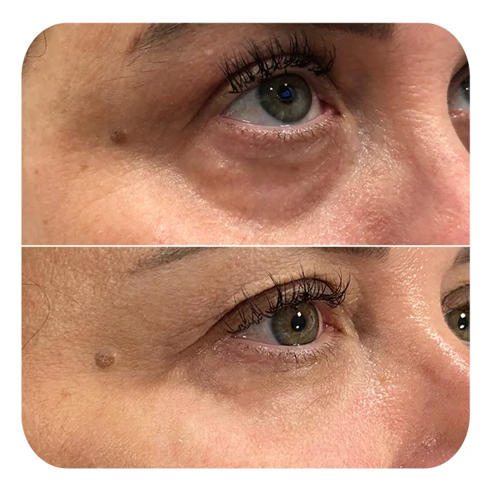 Fix eye treatment