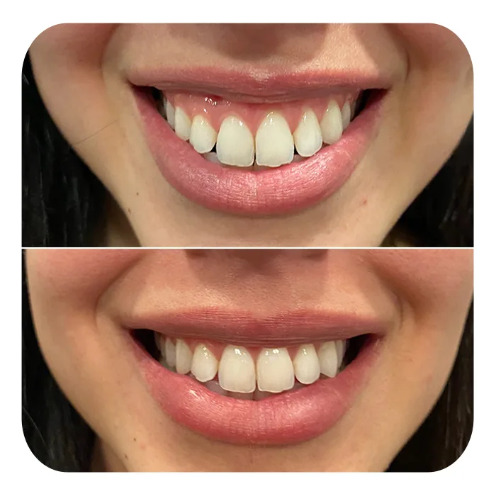 Gummy smile (2)
