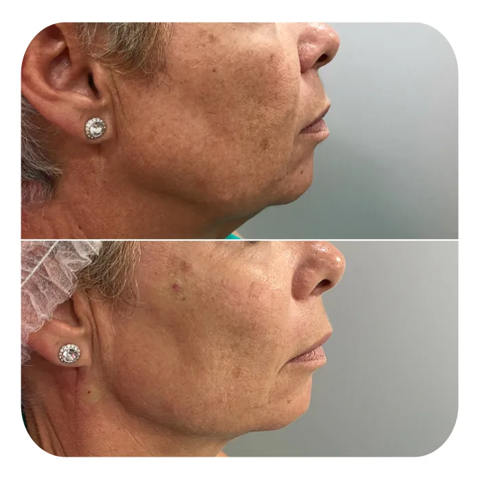 bionutri lift