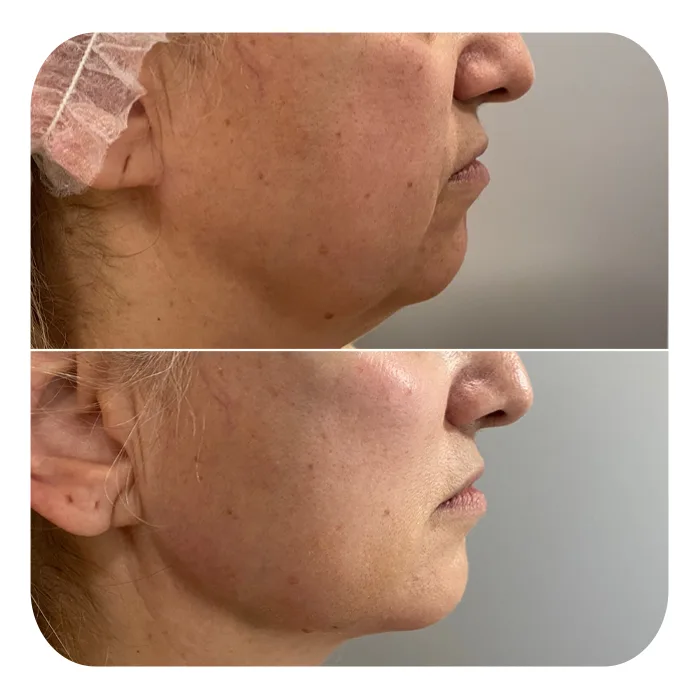 bionutri lift (1)
