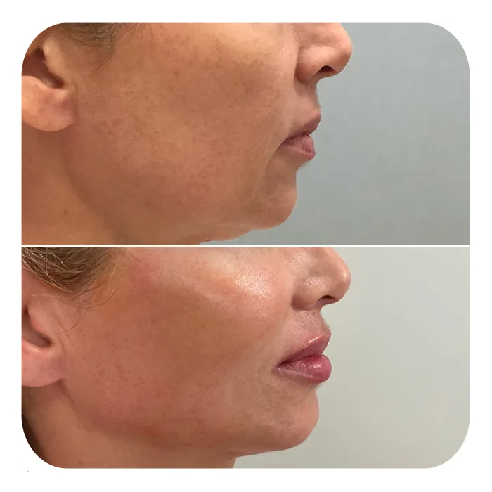 bionutri lift (2)