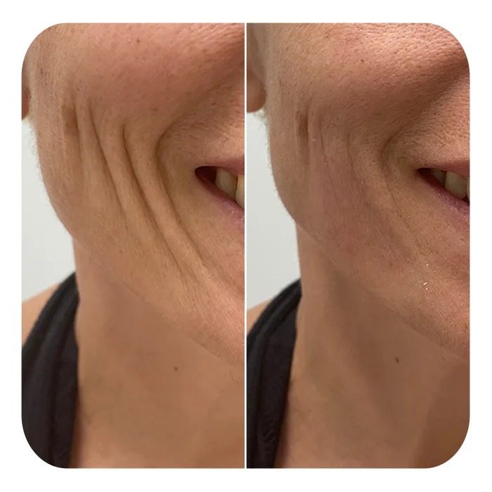 smile lines