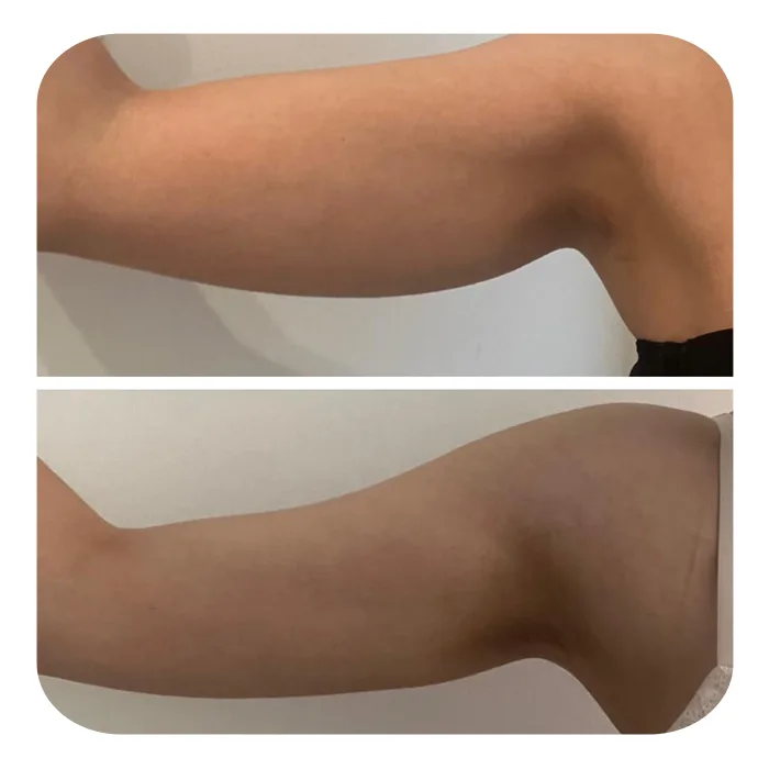 Braxionoplastiki_06