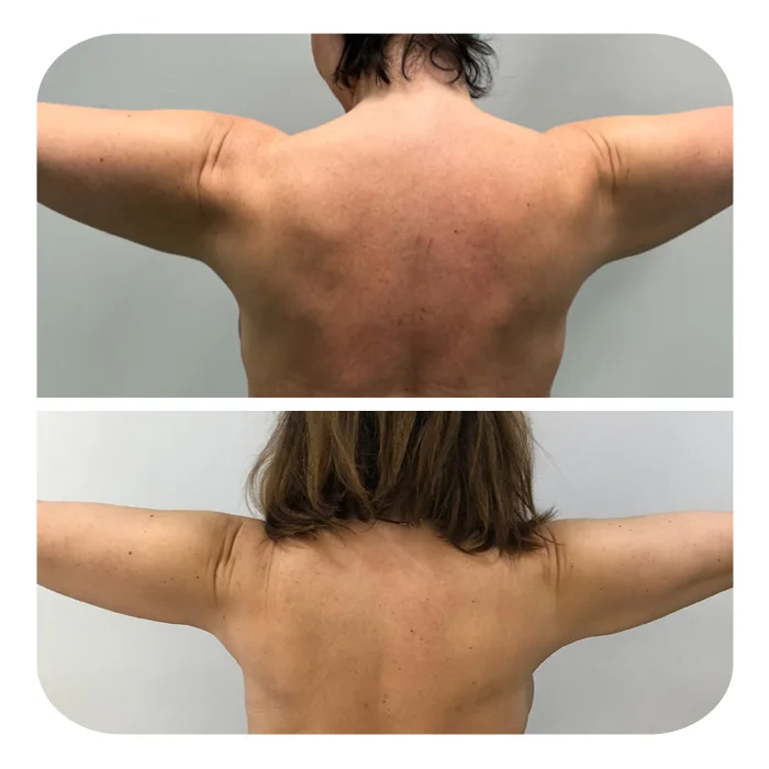 Braxionoplastiki_09