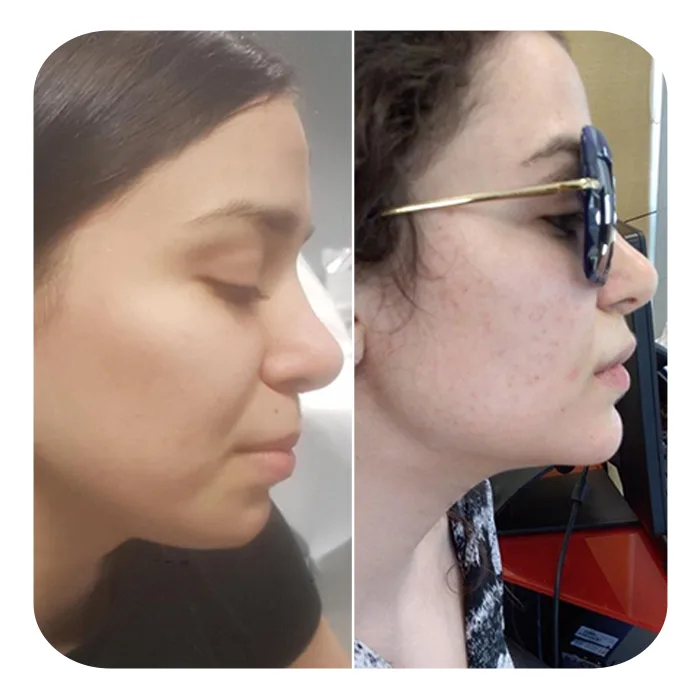Buccal fat 3