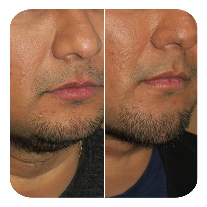 Buccal fat 4