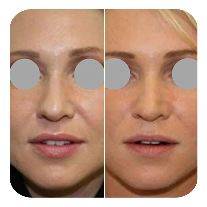 Buccal fat 5