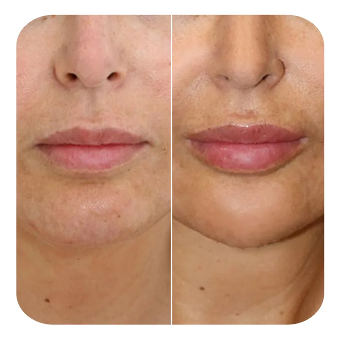 Buccal fat 6