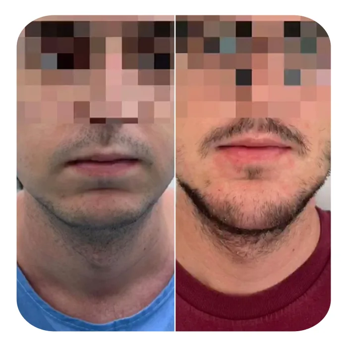 POGONOPLASTIKI_02