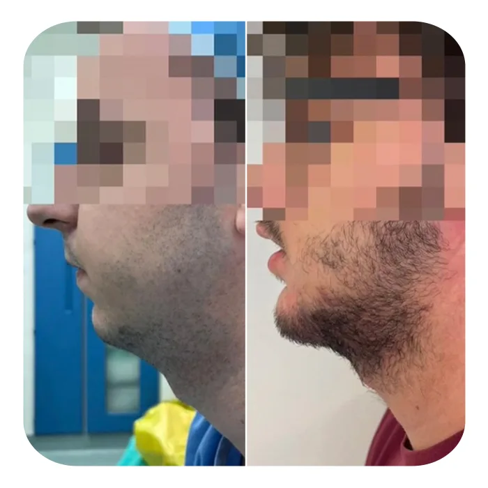 POGONOPLASTIKI_03