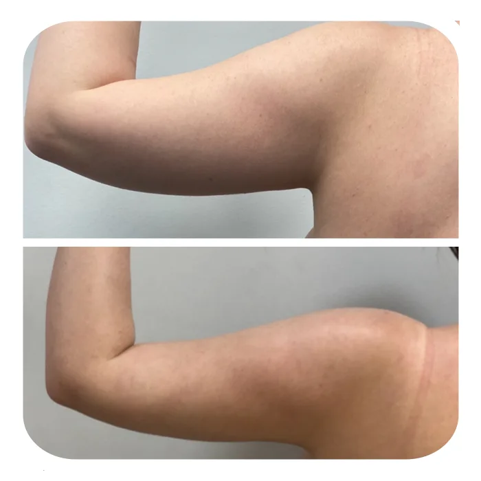Renuvion_Braxionoplastiki_04