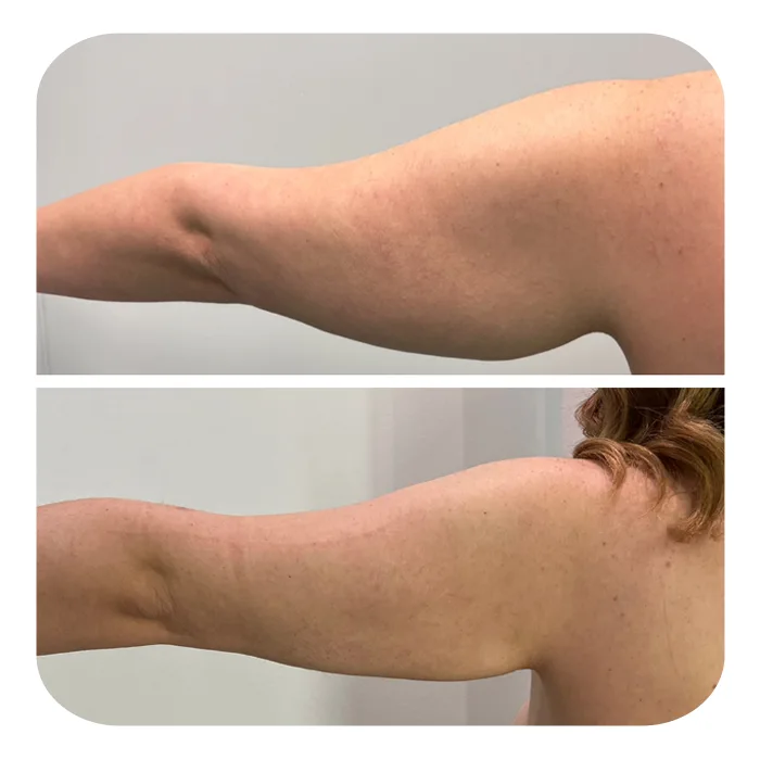 Renuvion_Braxionoplastiki_07