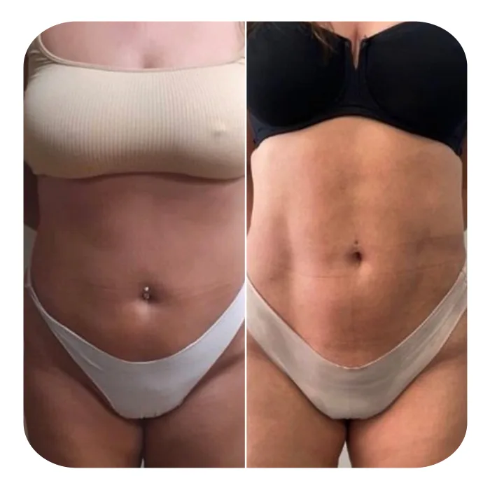 VASER LIPO HD_01