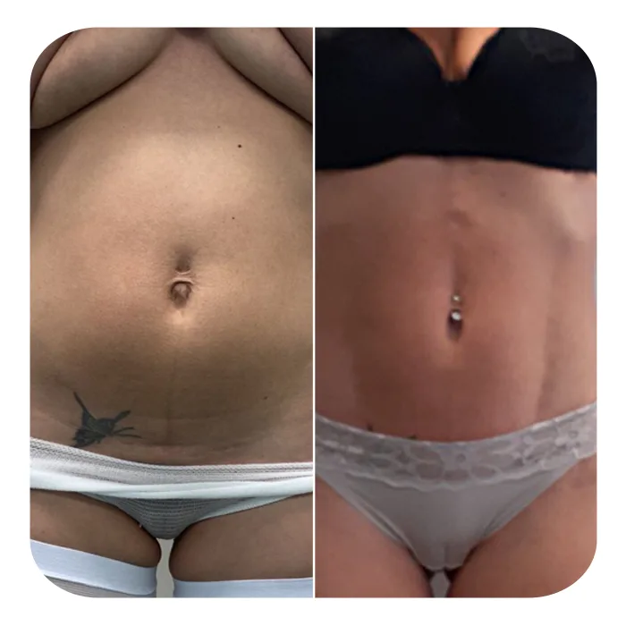 VASER LIPO HD_02