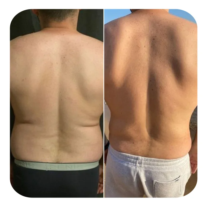 VASER LIPO HD_06