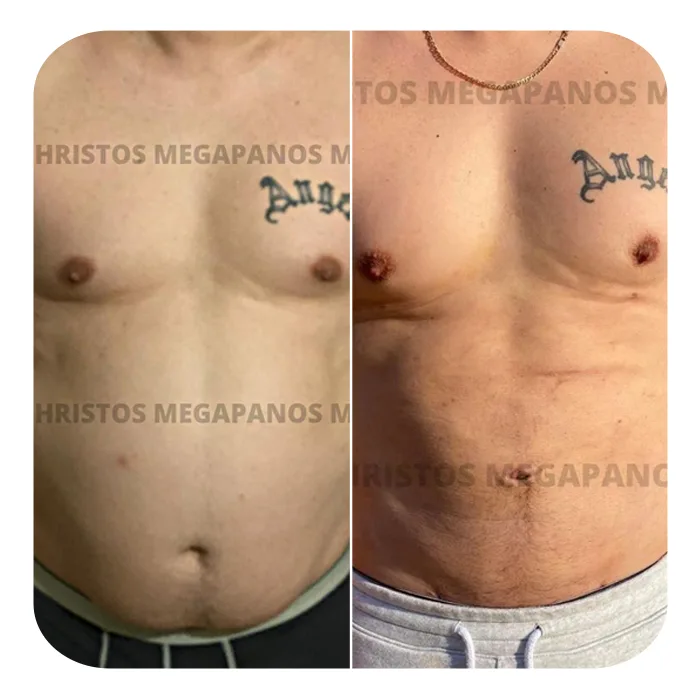 VASER LIPO HD_08