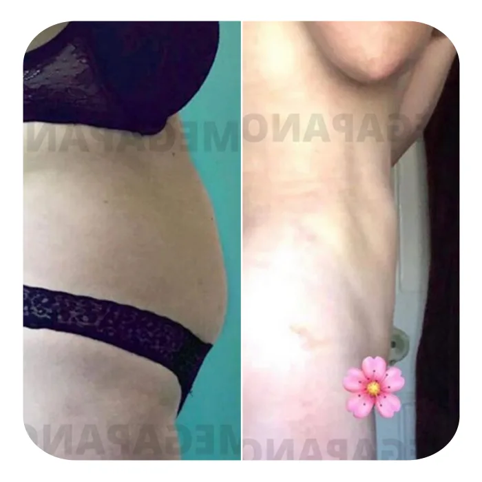 VASER LIPO HD_09