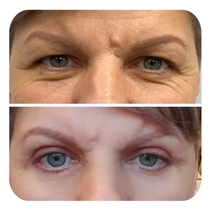 blefaroplastiki_01