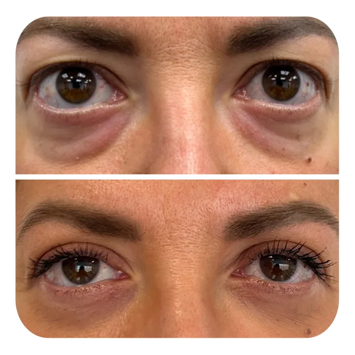blefaroplastiki_02