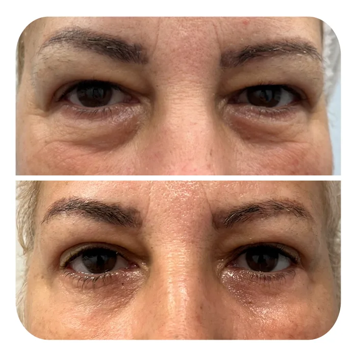 blefaroplastiki_03