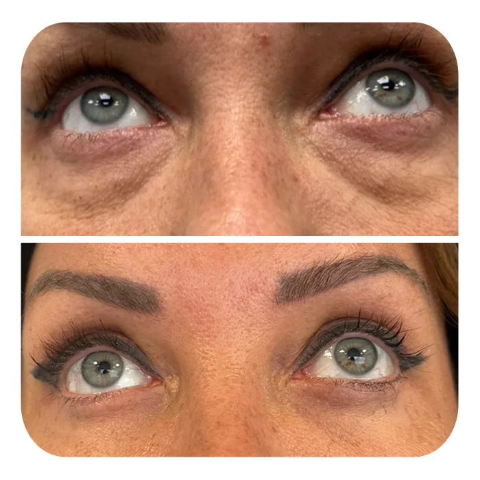 blefaroplastiki_04