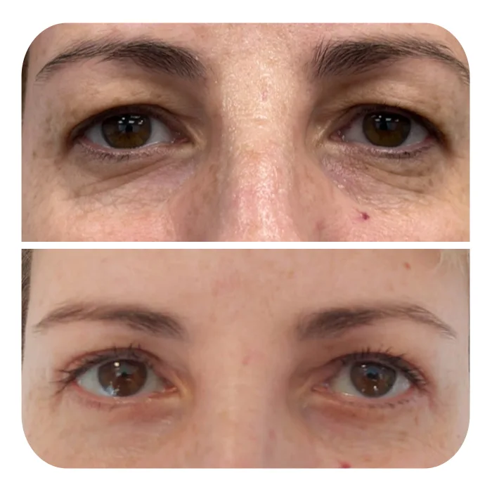 blefaroplastiki_06