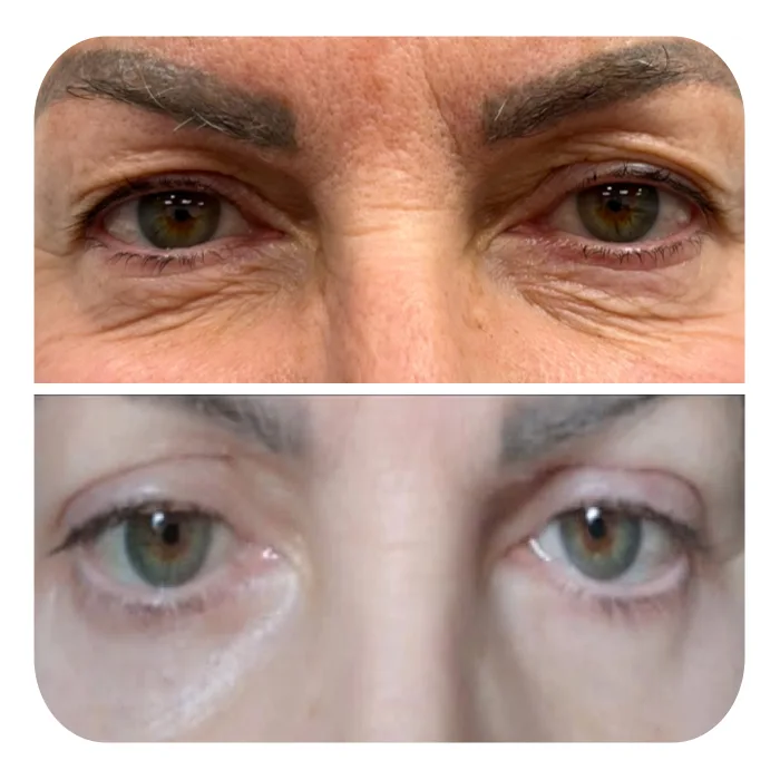 blefaroplastiki_07