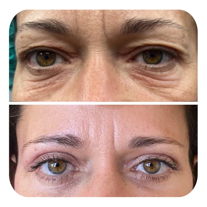 blefaroplastiki_08