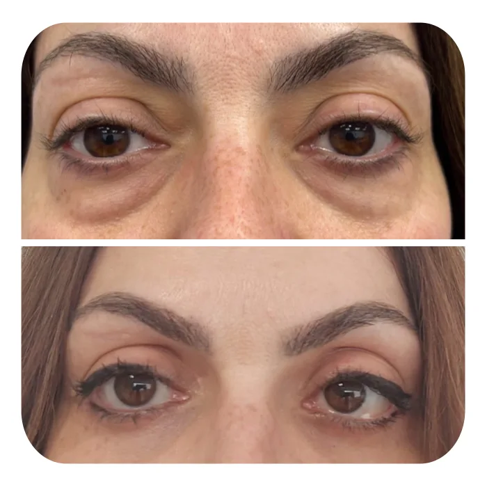 blefaroplastiki_09