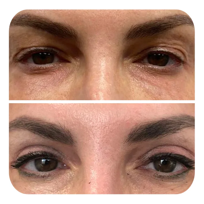 blefaroplastiki_10