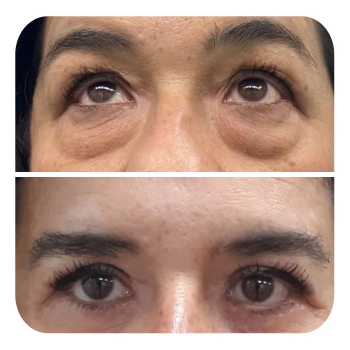 blefaroplastiki_11