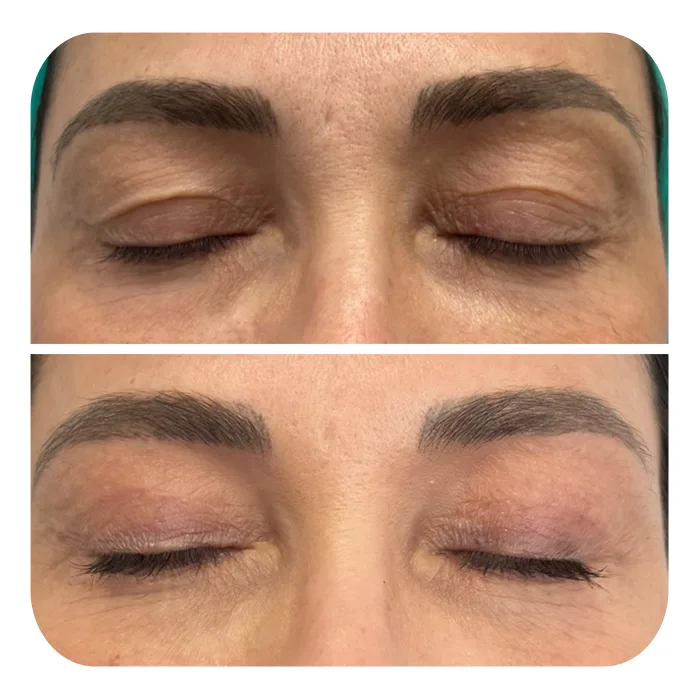 blefaroplastiki_12