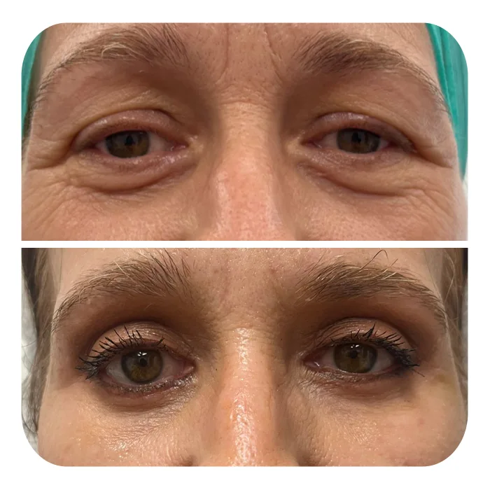 blefaroplastiki_13