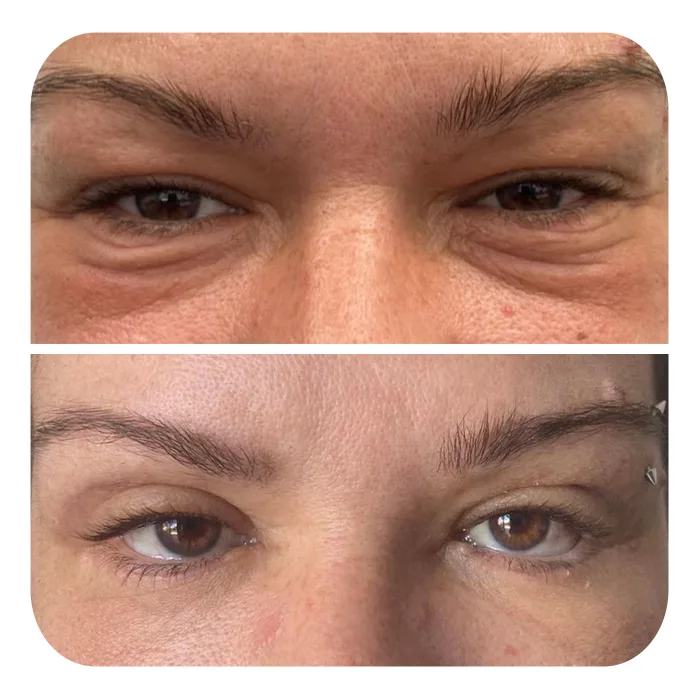blefaroplastiki_14