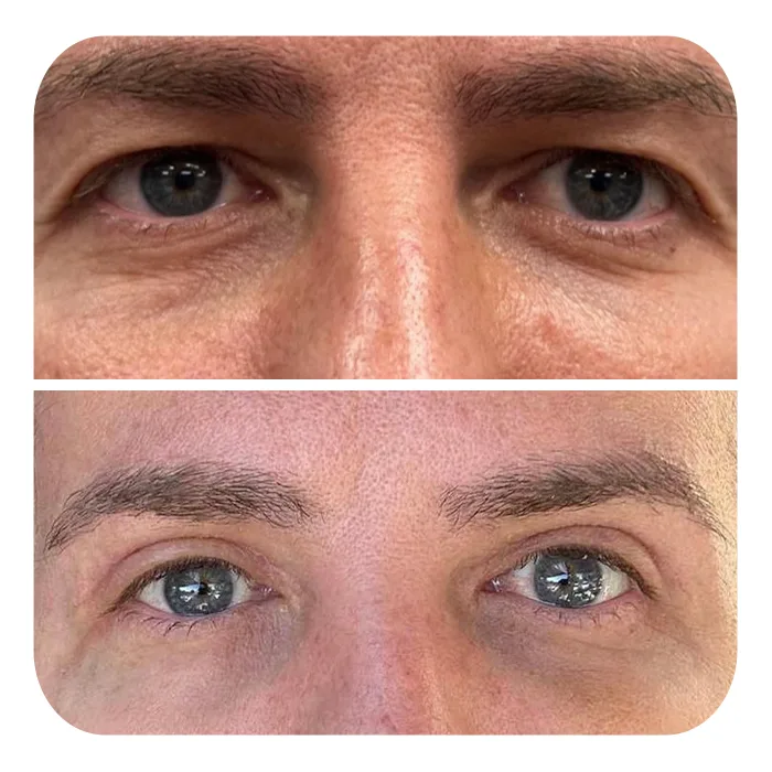 blefaroplastiki_15