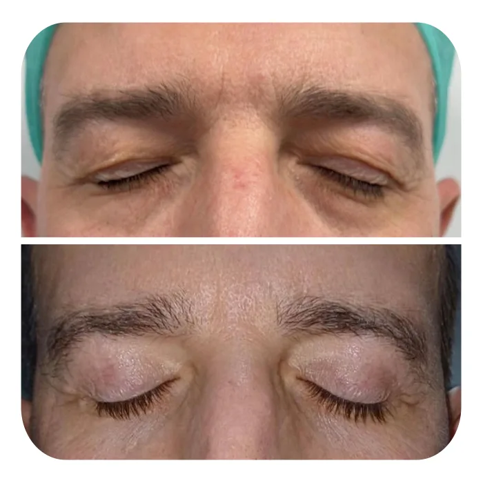blefaroplastiki_16