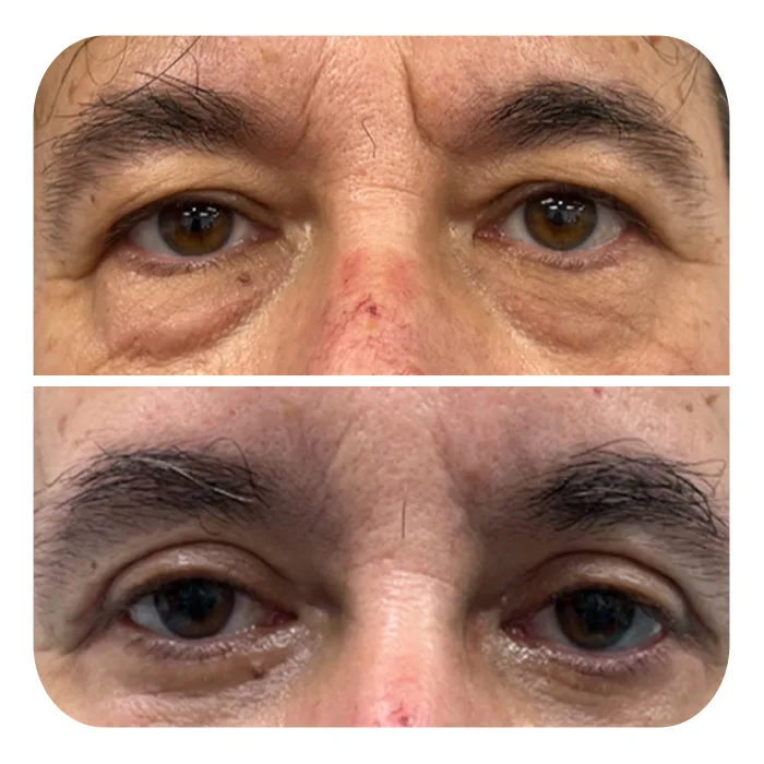 blefaroplastiki_18
