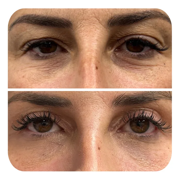 blefaroplastiki_19