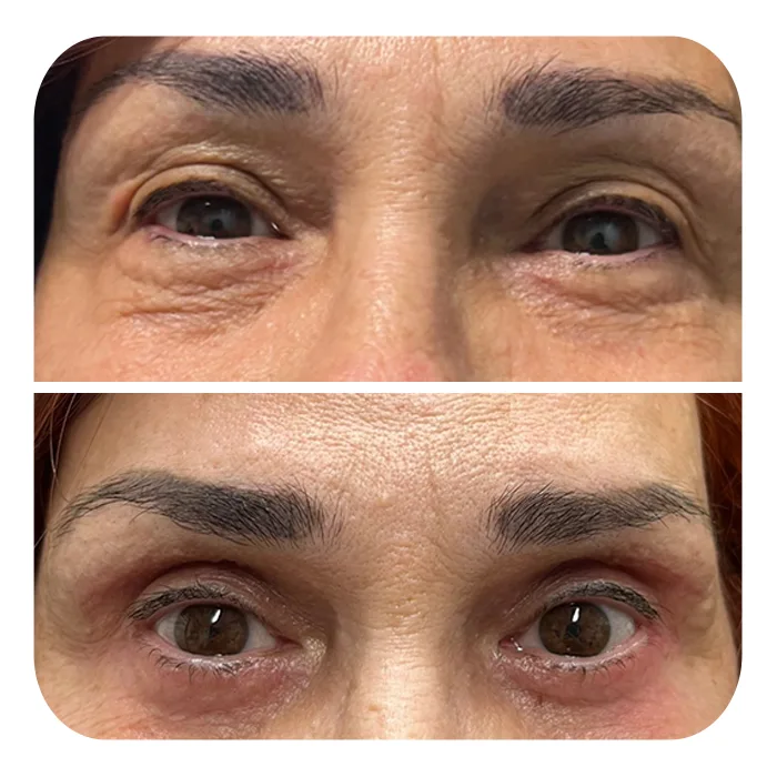 blefaroplastiki_20