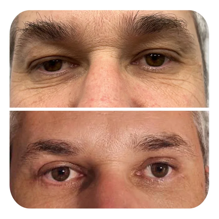 blefaroplastiki_21