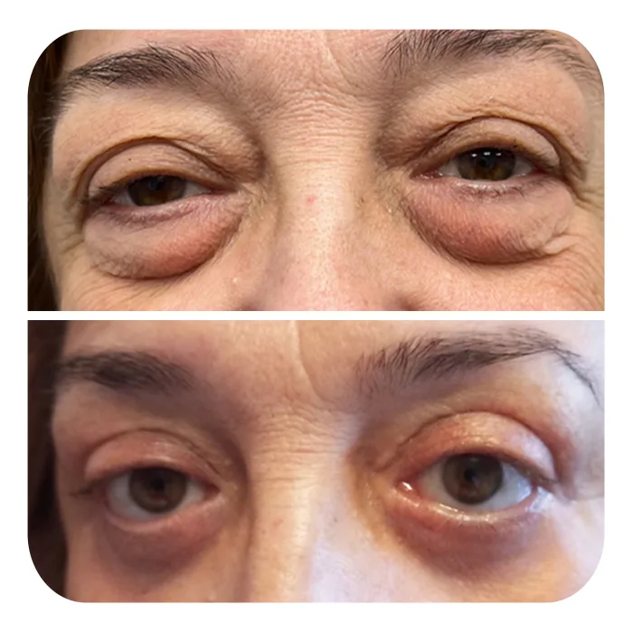 blefaroplastiki_22
