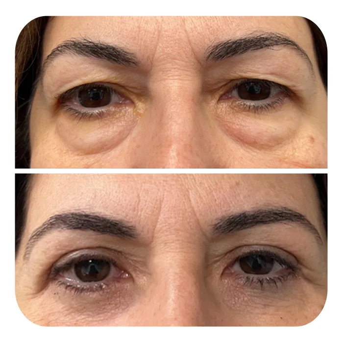 blefaroplastiki_23