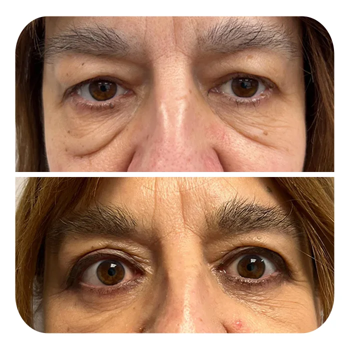 blefaroplastiki_24