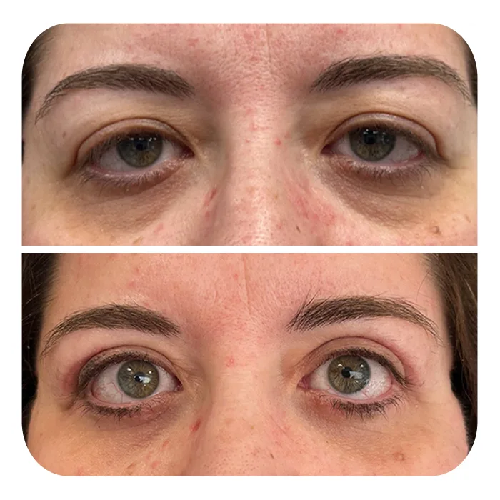 blefaroplastiki_25