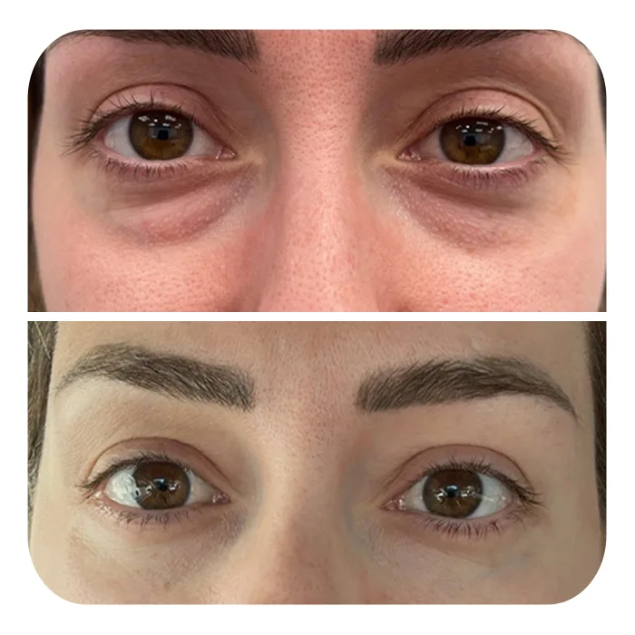 blefaroplastiki_26