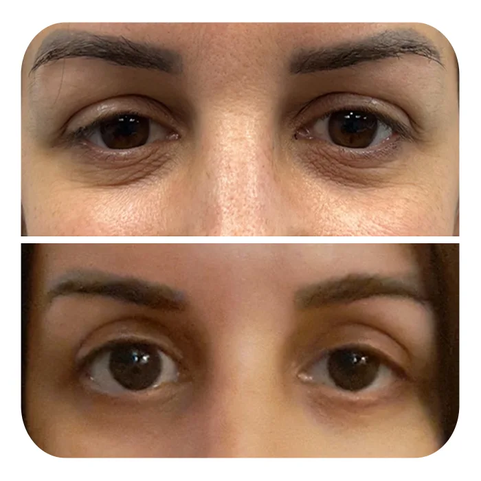 blefaroplastiki_27