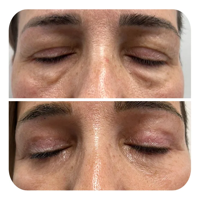 blefaroplastiki_29
