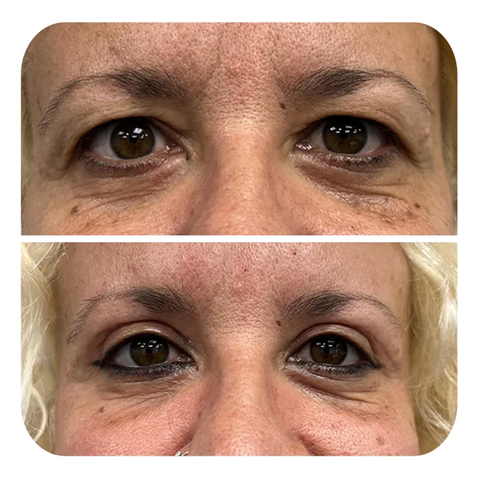 blefaroplastiki_30