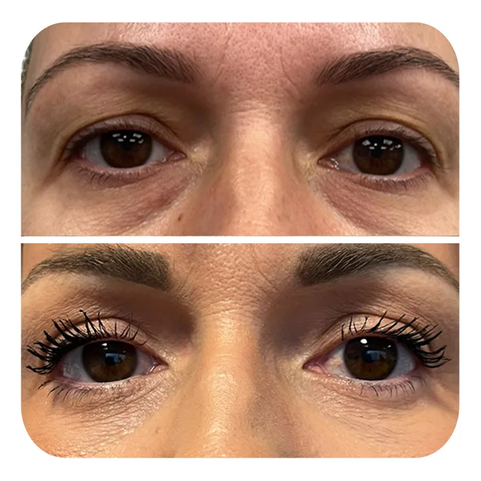 blefaroplastiki_31