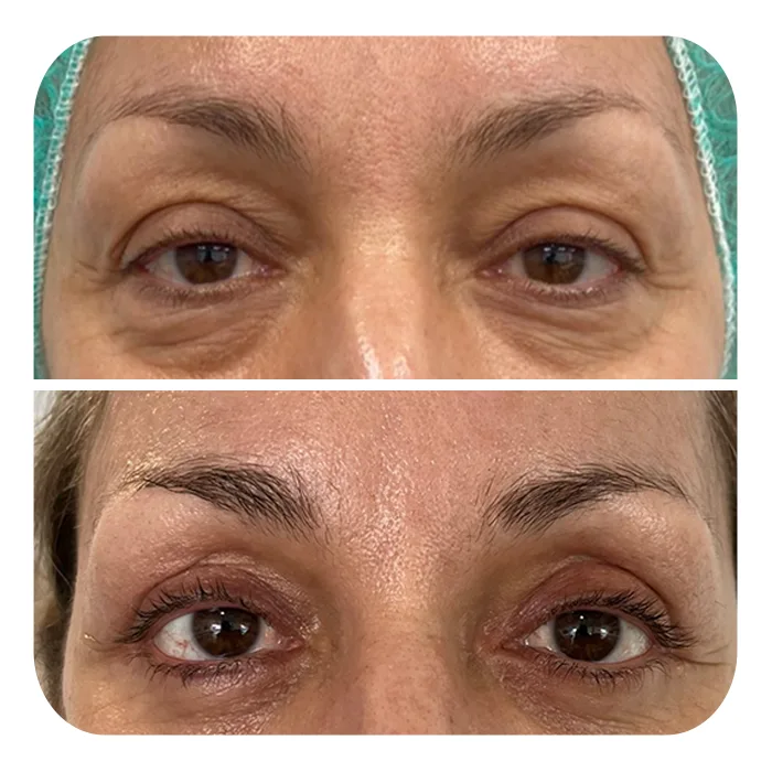 blefaroplastiki_32